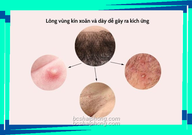 Ảnh về long vung kin anh huong suc khoe neu qua xoan va day